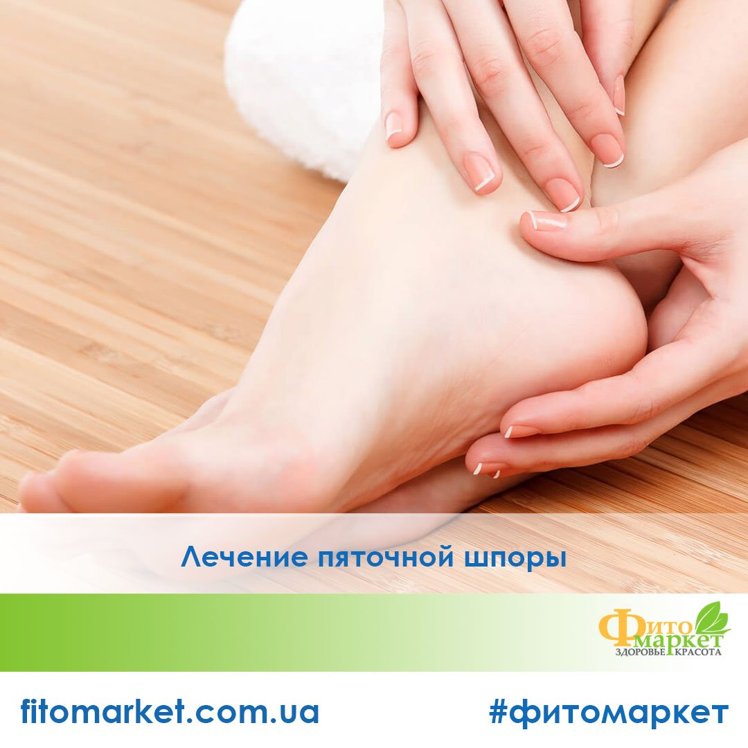 Лечение пяточной шпоры