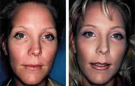 DrHaroldBafitis's tweet photo. Before/ after of CO2 Fractional Laser Surgery! https://t.co/BkUGyk6OAA #plasticsurgery #bafitisplasticsurgery #PalmBeach https://t.co/2UP9splHYL