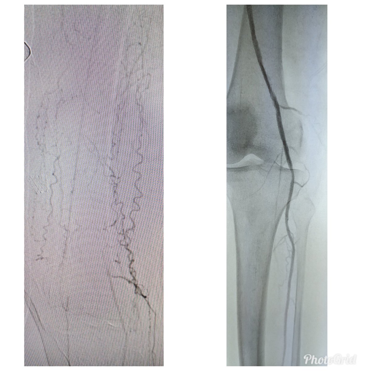 SOBE_Vascular's tweet image. 84 yo F RC4 #CLI @AbbottGlobal #commandwire to cross @MedtronicAPV #HawkoneS to debulk @BardPV #Lutonix DCB. #nometal @kmadass @SDhandMD @Mustapja @keithppereira @SriniTummala @AlexCVIR @FadiSaab17 @LessneVIR @Heartpower717 

Opinions on @BardPV poor Lutonix data in women?