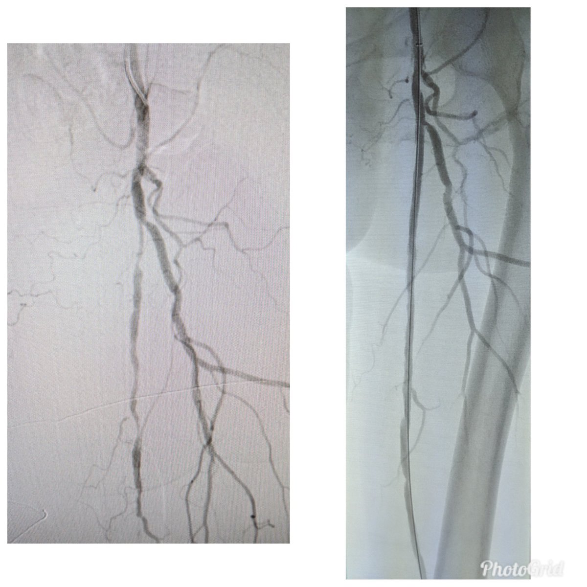 SOBE_Vascular's tweet image. 84 yo F RC4 #CLI @AbbottGlobal #commandwire to cross @MedtronicAPV #HawkoneS to debulk @BardPV #Lutonix DCB. #nometal @kmadass @SDhandMD @Mustapja @keithppereira @SriniTummala @AlexCVIR @FadiSaab17 @LessneVIR @Heartpower717 

Opinions on @BardPV poor Lutonix data in women?