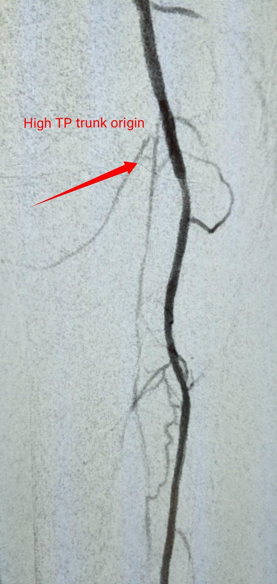SOBE_Vascular's tweet image. 84 yo F RC4 #CLI @AbbottGlobal #commandwire to cross @MedtronicAPV #HawkoneS to debulk @BardPV #Lutonix DCB. #nometal @kmadass @SDhandMD @Mustapja @keithppereira @SriniTummala @AlexCVIR @FadiSaab17 @LessneVIR @Heartpower717 

Opinions on @BardPV poor Lutonix data in women?