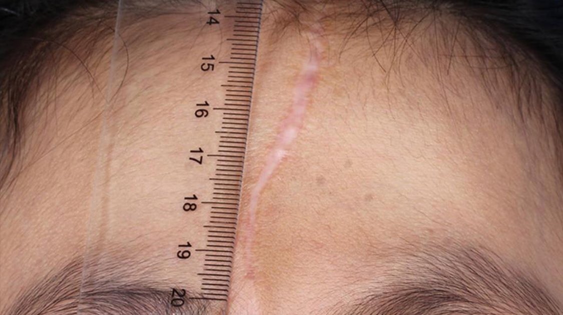 drheatherfurnas's tweet photo. #Botox can improve the outcome of facial scars @prsjournal https://t.co/3fxmYg3SSE #plasticsurgery #Scars https://t.co/3vpphNeuY7