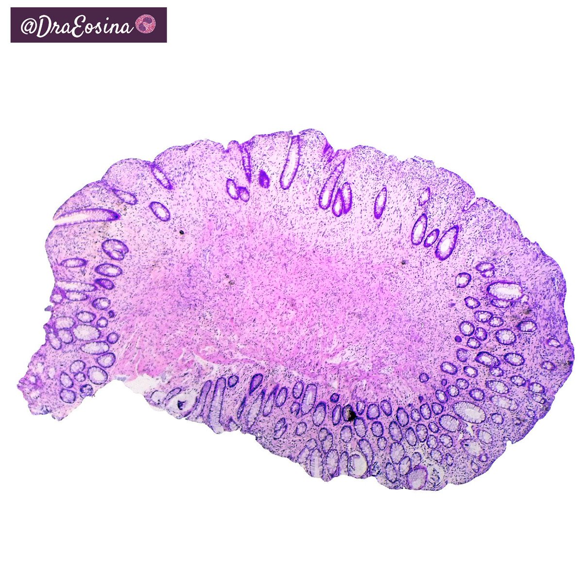 DraEosina's tweet photo. Colon BUMP! Mucosal Schwann cell Hamartoma. Kindly shared with me by @Elenacolcri, who should be posting these cases by herself! #GIPath #Pathology #Paz_Path https://t.co/X3vtnqSjvW