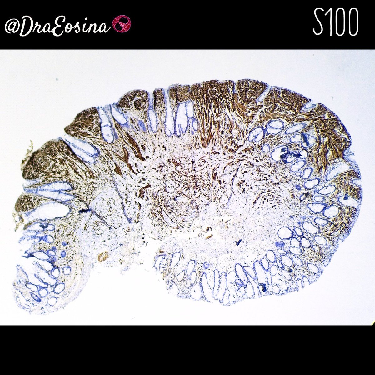 DraEosina's tweet photo. Colon BUMP! Mucosal Schwann cell Hamartoma. Kindly shared with me by @Elenacolcri, who should be posting these cases by herself! #GIPath #Pathology #Paz_Path https://t.co/X3vtnqSjvW