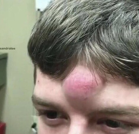 Si no le das RT, mañana te saldrá un grano así