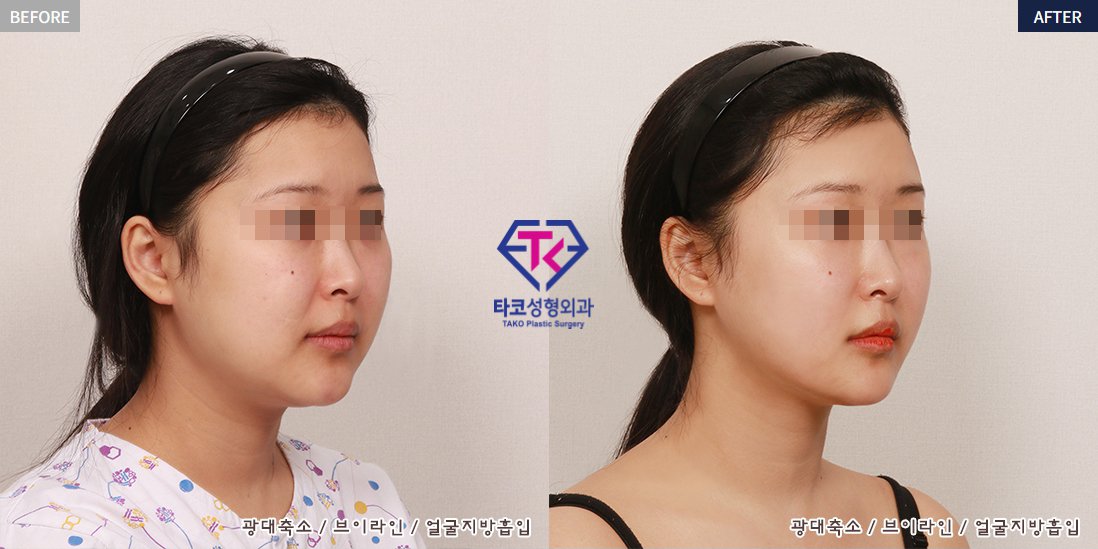 Tako美容外科 V Twitter 横顔 症例の患者様は vライン トリプル 頬骨縮小 顔の 脂肪吸引 を受けられました Tako美容外科 キムタクホ 輪郭 小顔