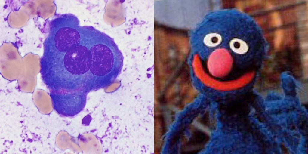 ForestHulsMD's tweet photo. Plasma cell with classic muppetoid morphology.
#pathology #HemePath https://t.co/tVqvkSCBnk