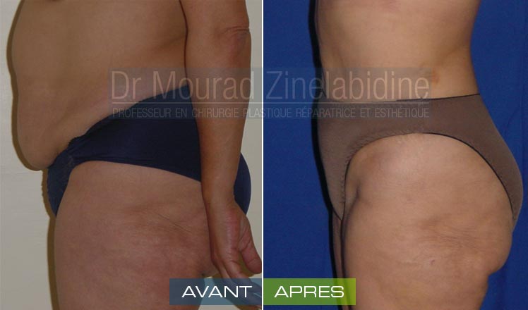 softesthetique's tweet photo. #CHIRURGIE #SILHOUETTE
#ABDOMINOPLASTIE #TUNISIE
par #Dr_Mourad_Zinelabidine
https://t.co/NZUEUvUknV https://t.co/bjAhikifbw