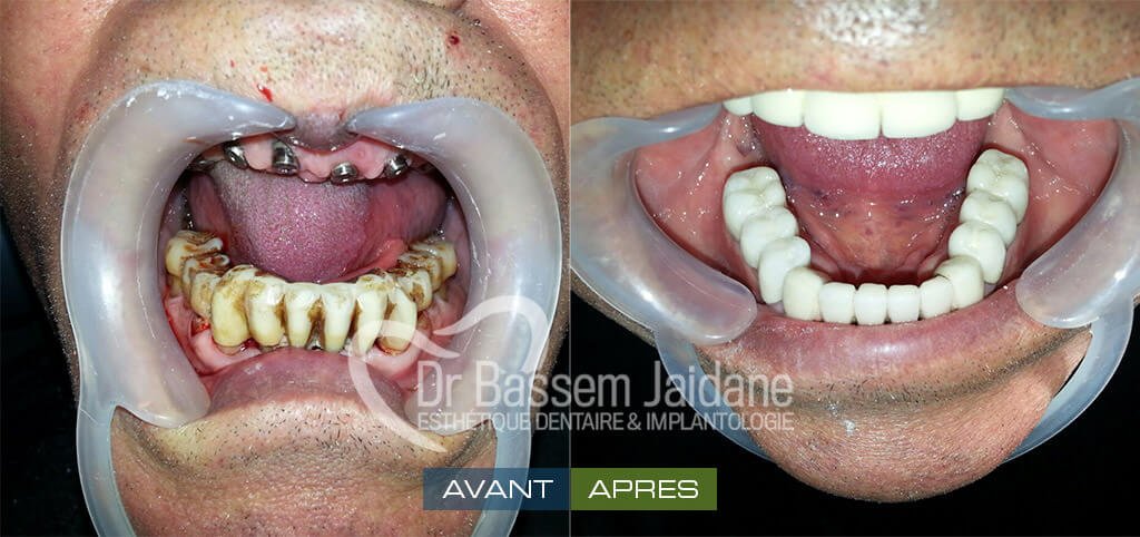 softesthetique's tweet photo. #SOINS #DENTAIRES
#IMPLANTS_DENTAIRES #TUNISIE
par #Dr_Bassem_Jaidane
https://t.co/fuALWZI8s5 https://t.co/f5ObemsrMh