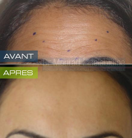 softesthetique's tweet photo. #MÉDECINE #ESTHÉTIQUE
#INJECTION #BOTOX #TUNISIE
par #Dr_Mourad_Zinelabidine
https://t.co/DjYlr6LZch https://t.co/QIKbvg9bLD