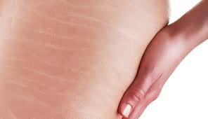 miss_ladymistic's tweet photo. COMO DISIMULAR LAS ESTRÍAS https://t.co/QWJH0qJoEb
#belleza #body #estrías #mujer #remedios #tips #beauty #consejos #beautyblogger #sigueme #blogs #blogger #remedioscaseros #bio #bodycare #salud #cuerpo #siguemiblog #womantips https://t.co/4ziOMcl482