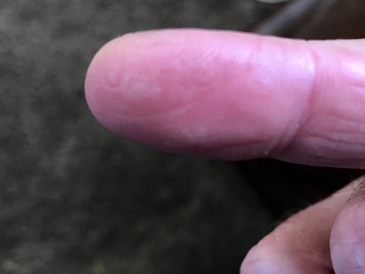 tkerstet's tweet photo. Well, apparently I branded myself this morning while making waffles for the boys! Ironically the letters U-A-H-C appear—these are letters from “chaude” (French for “hot”). Dumbass me! https://t.co/pGKj47xCKV