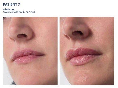 #Aliaxin #AliaxinFL #dermalfiller #dermalfillers #lips #lipinjections #lipaugmentation #lipenhancement 💋 #hyaluronicacid #Hydrolift #IBSA