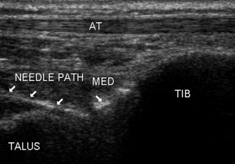 SMUGcourses's tweet photo. ultrasound-guided tibiotalar joint and sinus tarsi injections superior accuracy compared to non-guided injections
tibiotalar joint 100% guided vs 85% unguided
sinus tarsi 90%guided vs 35% unguided
@CMyersPhysio @lorenzo_masci https://t.co/ZDmkfiFMmM https://t.co/FN24dpkWgL