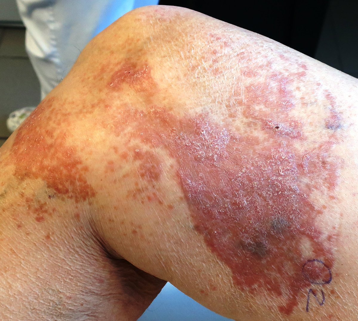 sortizreina's tweet photo. Cutaneous sarcoidosis in burns scar ( characteristic but rare form ).
Male 80YO with previous extensive burns scar in leg.                                               
Dermis: sarcoid granulomas without necrosis.
Dermpath# 
Pathology# https://t.co/RzRlo3mAoc