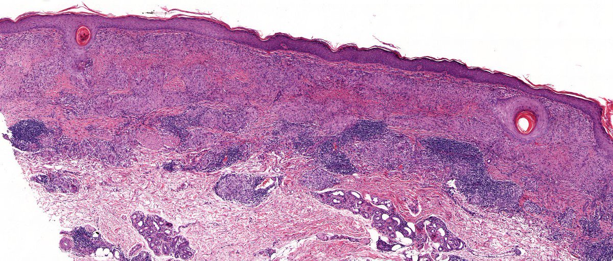 sortizreina's tweet photo. Cutaneous sarcoidosis in burns scar ( characteristic but rare form ).
Male 80YO with previous extensive burns scar in leg.                                               
Dermis: sarcoid granulomas without necrosis.
Dermpath# 
Pathology# https://t.co/RzRlo3mAoc