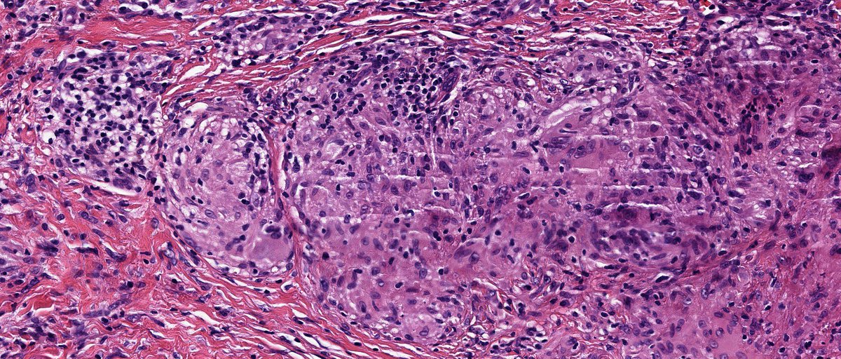 sortizreina's tweet photo. Cutaneous sarcoidosis in burns scar ( characteristic but rare form ).
Male 80YO with previous extensive burns scar in leg.                                               
Dermis: sarcoid granulomas without necrosis.
Dermpath# 
Pathology# https://t.co/RzRlo3mAoc