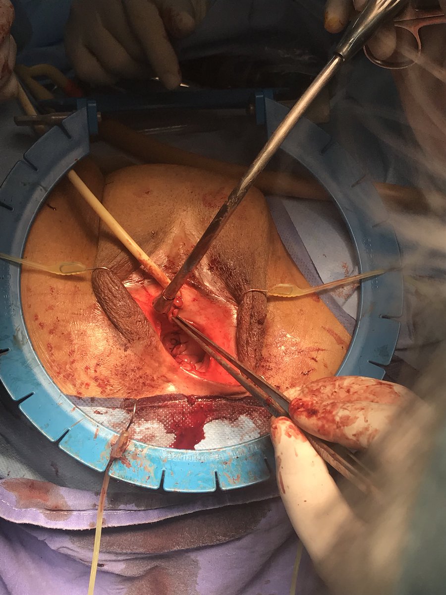 Nalle_am's tweet photo. Uretroplastia& cierre de fistula uretrovaginal& colpoplastia anterior y posterior & colpoeisis
#DRIGORVAZ #HRLALM @smumexico https://t.co/wGzzsa7gq5