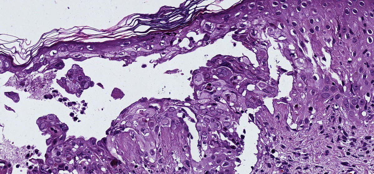 sortizreina's tweet photo. Herpesviridae disseminated infection.
Male 37YO. Thorax-abdomen disseminated erythematous papules and vesicles, some ulcerated.
Intraepithelial acantholytic blisters, multinucleated keratinocytes with ground-glass nucleus.
#dermopath
#pathology https://t.co/nmmzkwqWpf
