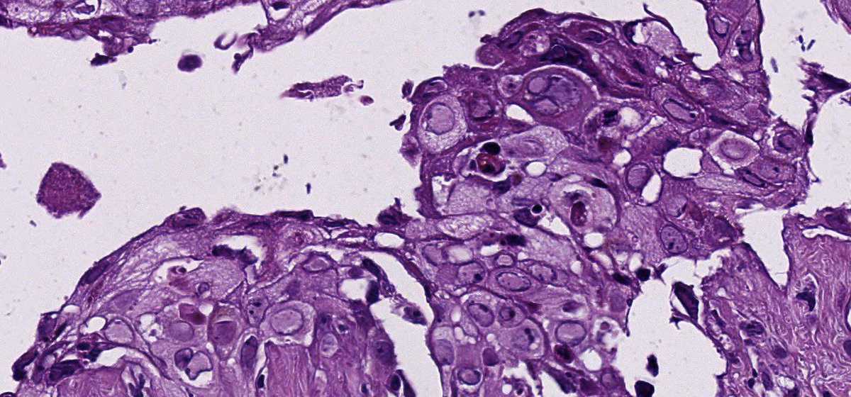 sortizreina's tweet photo. Herpesviridae disseminated infection.
Male 37YO. Thorax-abdomen disseminated erythematous papules and vesicles, some ulcerated.
Intraepithelial acantholytic blisters, multinucleated keratinocytes with ground-glass nucleus.
#dermopath
#pathology https://t.co/nmmzkwqWpf