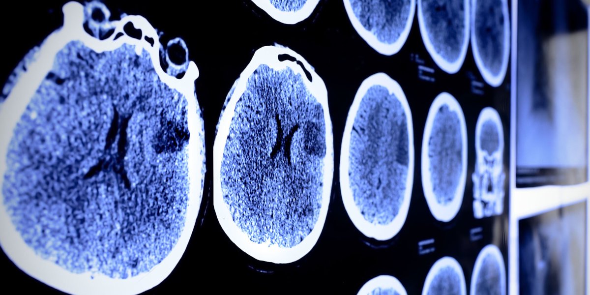 UTMDAnderson's tweet photo. Insights on #braintumors, including earlier diagnoses and the latest treatments, from our experts @J_deGrootMD and @DrJeffWeinberg: https://t.co/5cVz4bIQ7h #endcancer https://t.co/ag5vv9xDYx
