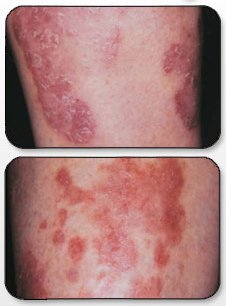 When the viciousness of #Psoriasis strikes, get the #skin relief you deserve. Check out how you can get a FREE solution here: lnk123.com/SHn7D