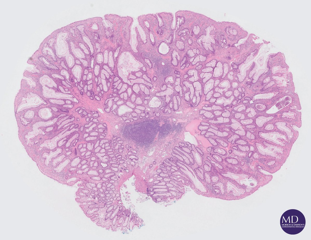 Morson GI pathology (@md_gipath) on Twitter photo Clean sweep in a young patient with Cowden's syndrome (PTEN-mutation documented), polyps from all major GI sites reveals the syndrome's phenotypic heterogeneity <a href="/DraEosina/">Laura G. Pastrián MD</a> <a href="/RhondaYantiss/">Rhonda Yantiss</a> <a href="/abobbyandrews/">Nicholas Wright</a> @gordon_hutchins Clean sweep in a young patient with Cowden's syndrome (PTEN-mutation documented), polyps from all major GI sites reveals the syndrome's phenotypic heterogeneity <a href="/DraEosina/">Laura G. Pastrián MD</a> <a href="/RhondaYantiss/">Rhonda Yantiss</a> <a href="/abobbyandrews/">Nicholas Wright</a> @gordon_hutchins