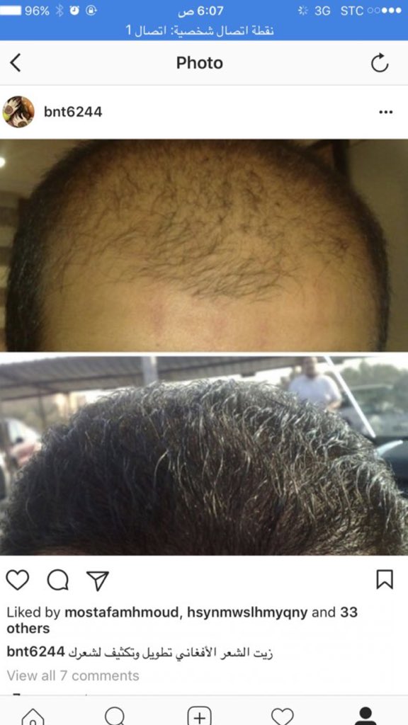 sh05521's tweet photo. زيت الحشيش الاصلي الخام ينبت الدقن والشنب ويكثفه يعالج التساقط ينعم يطول الشعر يمنع التساقط ويكثف الشعر الشحن مجاني لفترة محدودة👌🏻0557708990 https://t.co/8vAoUYIrvM