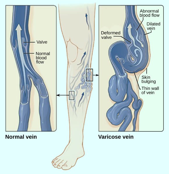 In the #news: "Varicose Veins Linked to Increased Risk of Deep Venous Thrombosis" Read more via @scinewscom qoo.ly/mr6t7