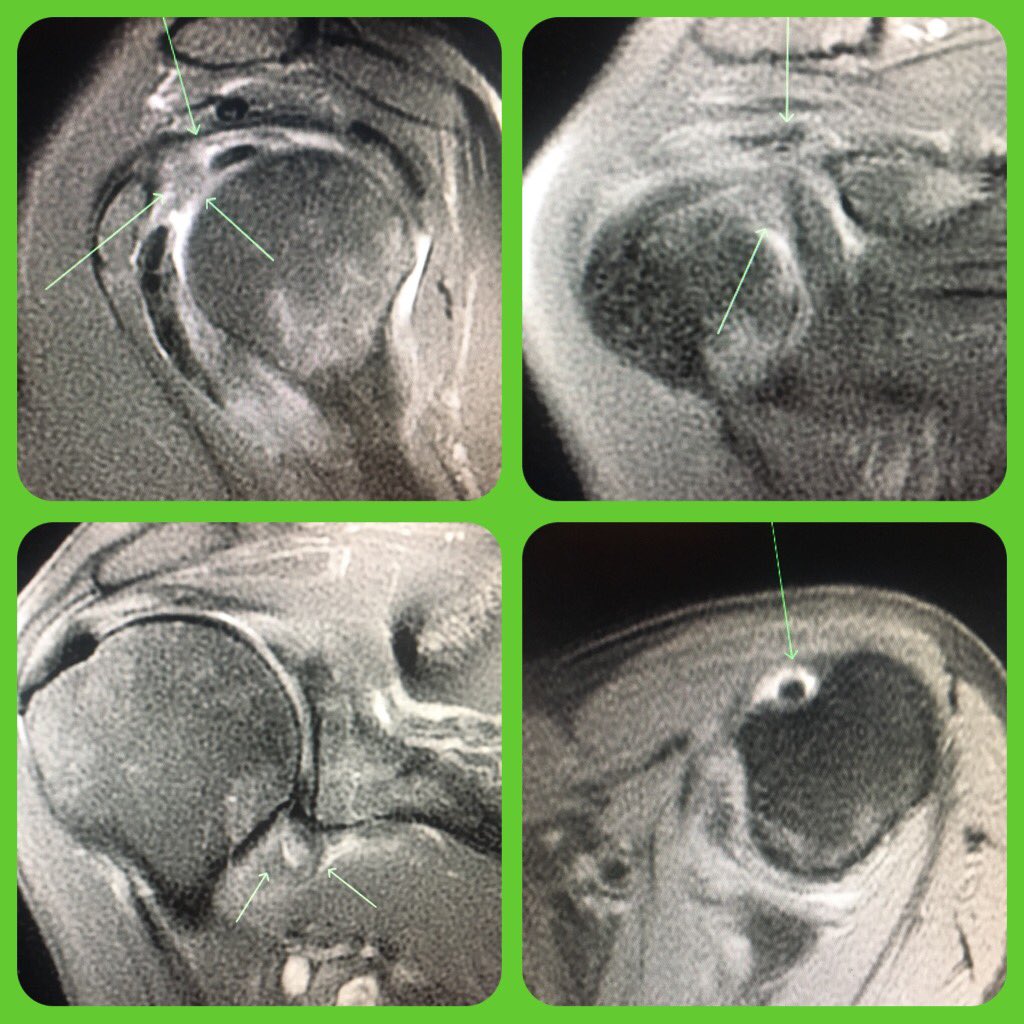 Nice example of adhesive capsulitis of the shoulder! 
MRI:
- Synovitis at cuff interval - Edema at inferior capsule
- Joint fluid filling biceps sheath, excluded from joint recesses 
Common clinical:
- Loss of ROM, pain
- Middle aged female
- Following injury
