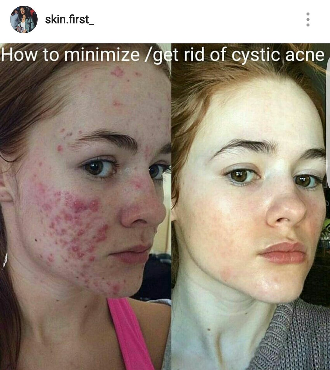 cystic acne dark spots