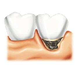 AliZpta's tweet photo. @ProyectoVi  #saludbucodental  Una de las cifras criticas en salud oral se encuentra en el ENSAB IV, donde se realiza un análisis de la caries radicular en una población entre 45 y 64 años, lo que indica que se presenta una prevalencia del 31.08% de la población evaluada. https://t.co/a9R2QuofX6