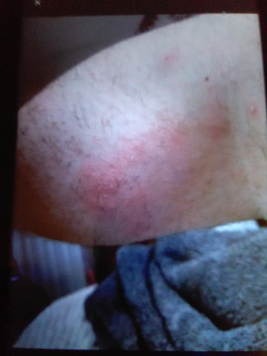 pmbarnes417's tweet photo. The Healing Powers Of #MysticRosCreations  In Just 4 Days
Prescription Meds DID NOT WORK !
#skincare #ChronicPain #migraines #MRSA #BackPain #kneepain #sports #injury #arthritis #Fibromyalgia #hemp #cbd #dermatology #Investors No Risk #investment 
 https://t.co/uB69MY8qcR https://t.co/ZByIeiEPj1