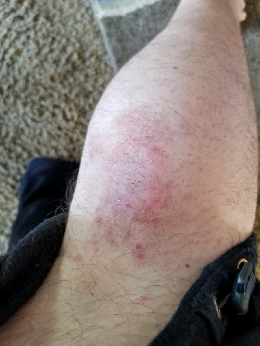 pmbarnes417's tweet photo. The Healing Powers Of #MysticRosCreations  In Just 4 Days
Prescription Meds DID NOT WORK !
#skincare #ChronicPain #migraines #MRSA #BackPain #kneepain #sports #injury #arthritis #Fibromyalgia #hemp #cbd #dermatology #Investors No Risk #investment 
 https://t.co/uB69MY8qcR https://t.co/ZByIeiEPj1