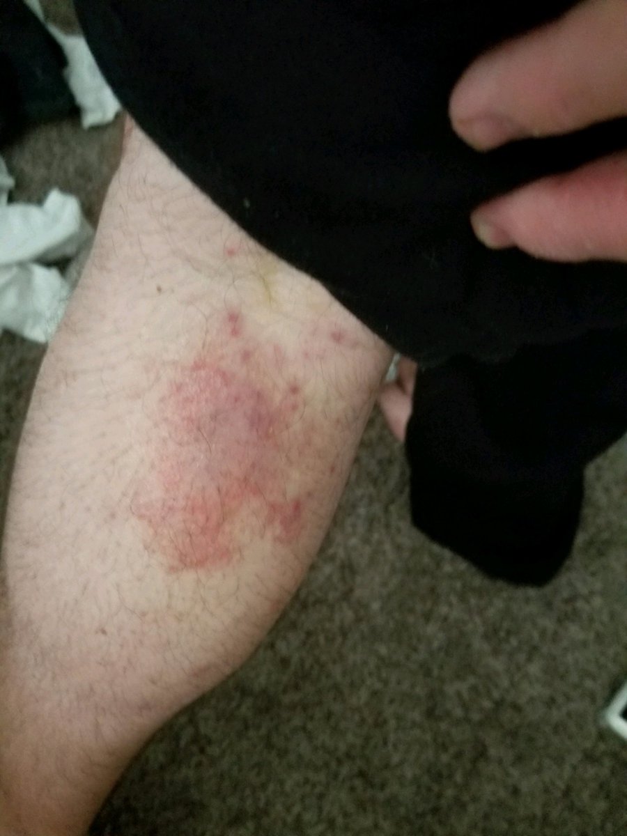 pmbarnes417's tweet photo. The Healing Powers Of #MysticRosCreations  In Just 4 Days
Prescription Meds DID NOT WORK !
#skincare #ChronicPain #migraines #MRSA #BackPain #kneepain #sports #injury #arthritis #Fibromyalgia #hemp #cbd #dermatology #Investors No Risk #investment 
 https://t.co/uB69MY8qcR https://t.co/ZByIeiEPj1