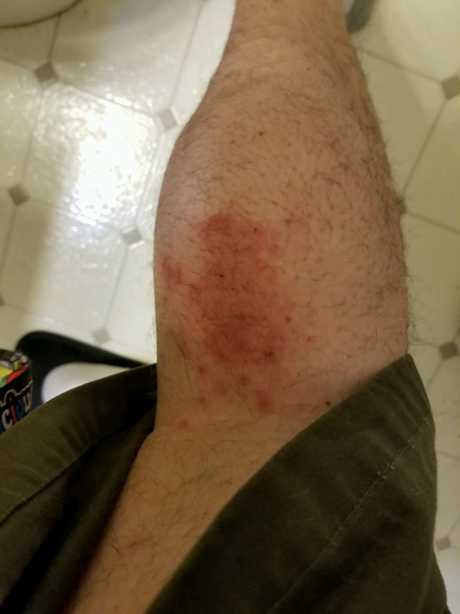 pmbarnes417's tweet photo. The Healing Powers Of #MysticRosCreations  In Just 4 Days
Prescription Meds DID NOT WORK !
#skincare #ChronicPain #migraines #MRSA #BackPain #kneepain #sports #injury #arthritis #Fibromyalgia #hemp #cbd #dermatology #Investors No Risk #investment 
 https://t.co/uB69MY8qcR https://t.co/ZByIeiEPj1