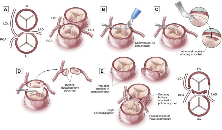 Translocation of intramural coronary artery in arterial switch by Fricke and Konstantinov in April JTCVS bit.ly/2CZYgymJTCVS <a href="/tssmn/">CTSurgSocMedNetwork</a> <a href="/DrM_Liavaa/">Matthew Liava'a MD</a> <a href="/ArieBlitzMD/">Arie Blitz, MD, MBA</a> <a href="/OuzounianMD/">Maral Ouzounian</a> <a href="/drnikkistamp/">Dr Nikki Stamp FRACS</a> <a href="/maraantonoff/">Mara Antonoff, MD, FACS</a> <a href="/maraantonoff/">Mara Antonoff, MD, FACS</a>