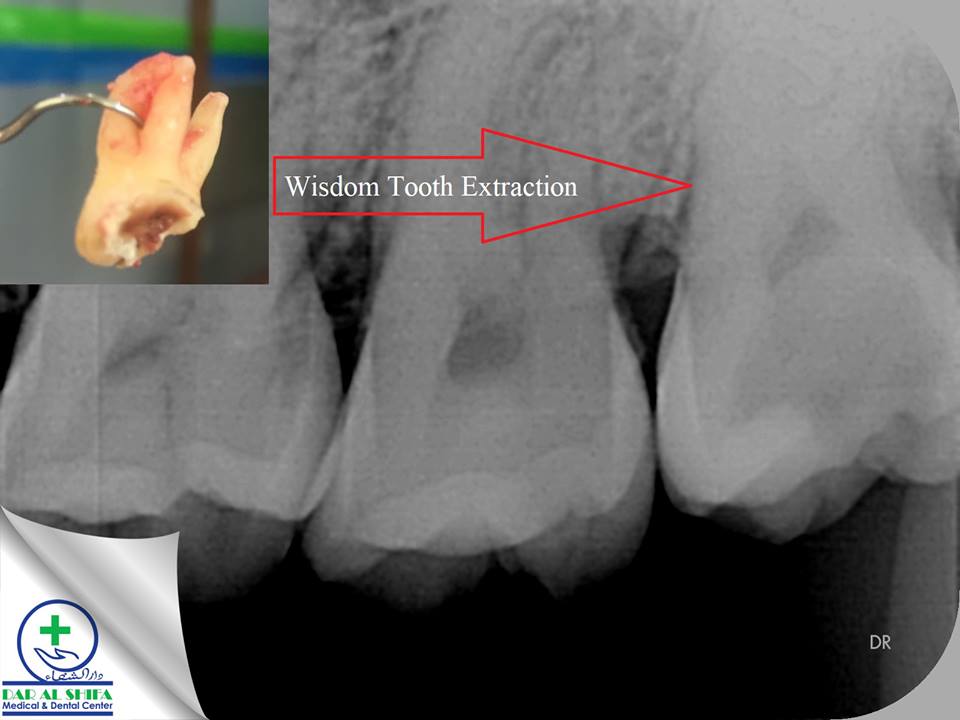 dar_center's tweet photo. Patient came with sever pain at upper left region,pain was radiating to ear and head, after Clinical Examination&amp; X-Ray,carious upper Wisdom Tooth (Third Molar) was detected &amp; Extraction was done under Local Anesthesia

For more info &amp; appointments:
call☎021-35171191

#Dentist https://t.co/0dbD8fAYVv