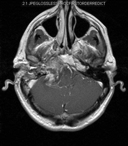 JennyKHoang's tweet image. Awesome Skull Base Case I didn't show at #DukeReview: 
#Radres Diagnosis?
ANSWER: goo.gl/w51meK