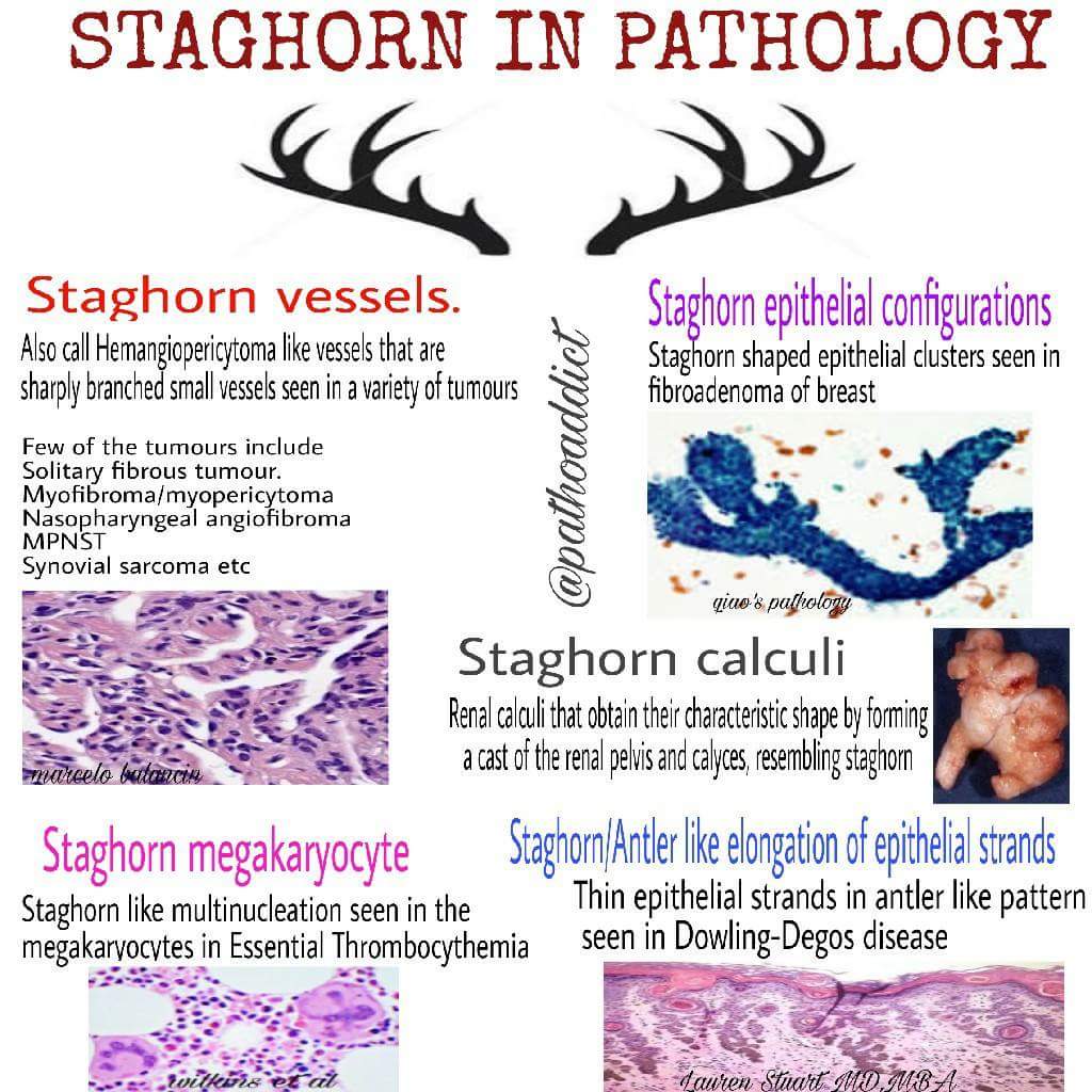 faheema_hasan's tweet photo. Don't we love to compare to pretty things in life..
Here is one such..
Use of "staghorn" in pathology #pathology #pathologists #pathboards @pembeoltulu https://t.co/TmX4yBWJRT