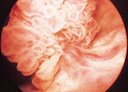 AFUrologie's tweet photo. #AFUscience #Cancer de la vessie chez le patient neurologique: état de l’art et résultats de l’enquête nationale épidémiologique française https://t.co/u5Jk8YxZnc https://t.co/klan2bLIY0