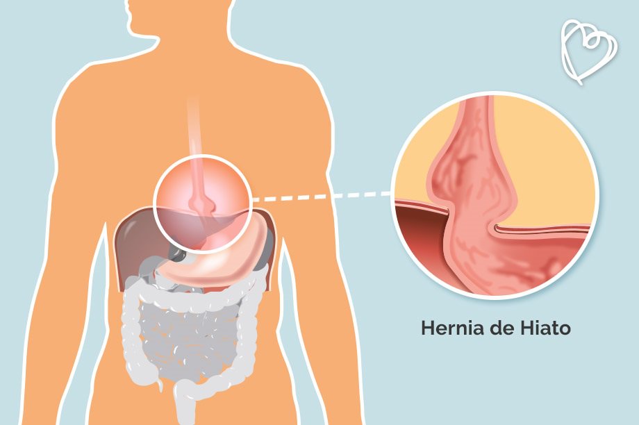 saludabit's tweet photo. Cómo identificar una #hernia de hiato https://t.co/J5LIFZCd4t https://t.co/KtI8hK5Li7