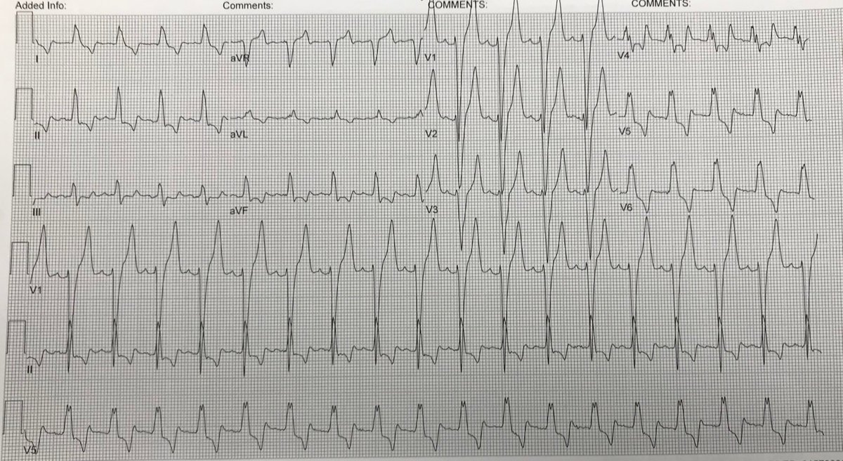 #Hyperkalemia in three ECGs:
1. Presenting #ECG: Elderly male with 24h of weakness. Ca and other tx given immediately (K later results 9.7)
2. QRS/TWs better. Rhythm worse! Second round of Ca etc.
3. P waves arrive in time for dialysis.
#foamed <a href="/amalmattu/">Amal Mattu</a>