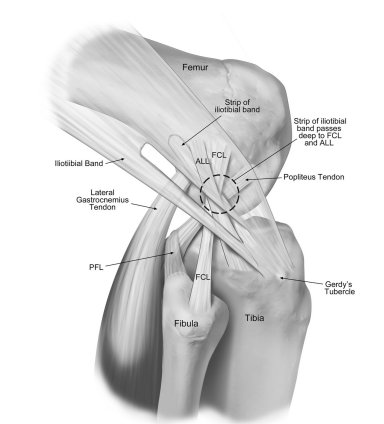 thekneedoc's tweet photo. This study investigated the biomechanical properties of anatomic #ALLreconstruction &amp; a modified Lemaire procedure in combination with #ACLreconstruction as compared with isolated ACL reconstruction in the setting of deficient #anterolateral structures https://t.co/0orTOlNdvi https://t.co/YqqbVKmLMo