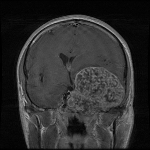 JennyKHoang's tweet photo. Call me crazy, but I think enhancement pattern of skull base #chondrosarcoma on MRI looks like a pumice stone. #pumicesign #radres 

Anyone have a #radpathmatch? https://t.co/xvJBhIEnxN