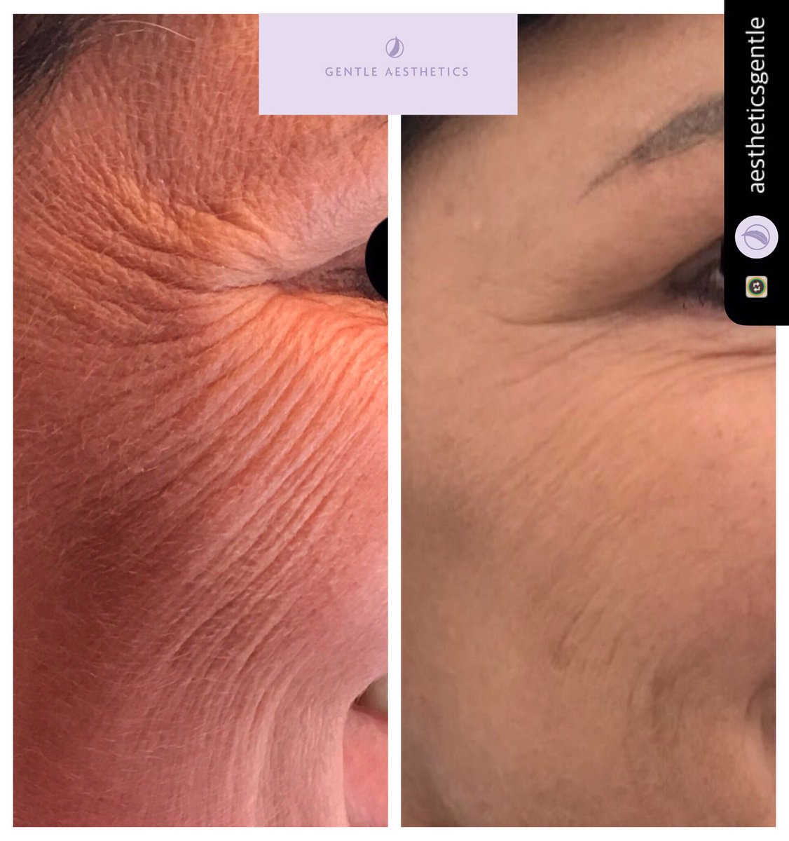 #Profhilo #bioremodelling #collagen #elastin #skin #skinquality #skinlaxity #hyaluronicacid #antiageing #lovedbypatients