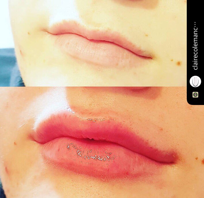 #Aliaxin #dermalfiller #dermalfillers #Hydrolift #IBSA #hyaluronicacid #hyaluronicacidexperts #lips #lipenhancement #lipaugmentation 💋