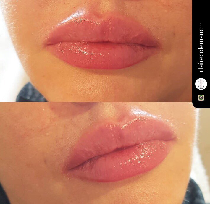 #Aliaxin #dermalfiller #dermalfillers #Hydrolift #IBSA #hyaluronicacid #hyaluronicacidexperts #lips #lipenhancement #lipaugmentation 💋