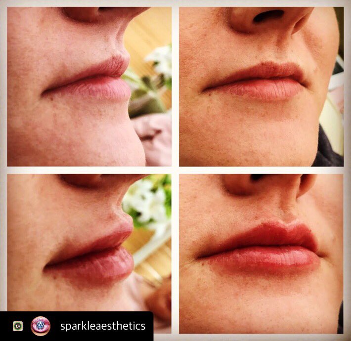 #Aliaxin #dermalfiller #dermalfillers #Hydrolift #IBSA #hyaluronicacid #hyaluronicacidexperts #lips #lipenhancement #lipaugmentation 💋