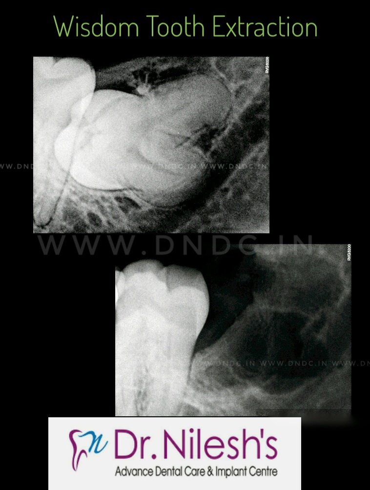 dndc_Pune's tweet photo. Wisdom tooth extraction
Pederson's  difficulty Index of Wisdom tooth extraction.
1)Space Relationship-Horizontal-2
2)Depth-Type C-Deep Occulsal -3
3)Ramus Relationship space available-Class 3- No Space-3
Difficulty Index. - Score 8 (Very Difficult Case completed surgically. https://t.co/ABTcyNQZqR